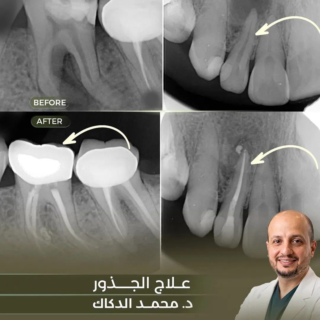 Root Canal Treatment before and after, Dr. Mohammad Al-Dakkak, Lavie Riyadh